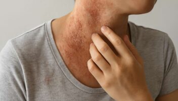 dermatitis atopica